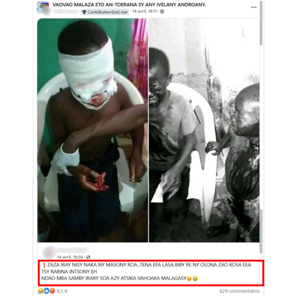 Un enfant à qui on aurait arraché les yeux ? Ce que révèle Google Lens sur l’origine des images